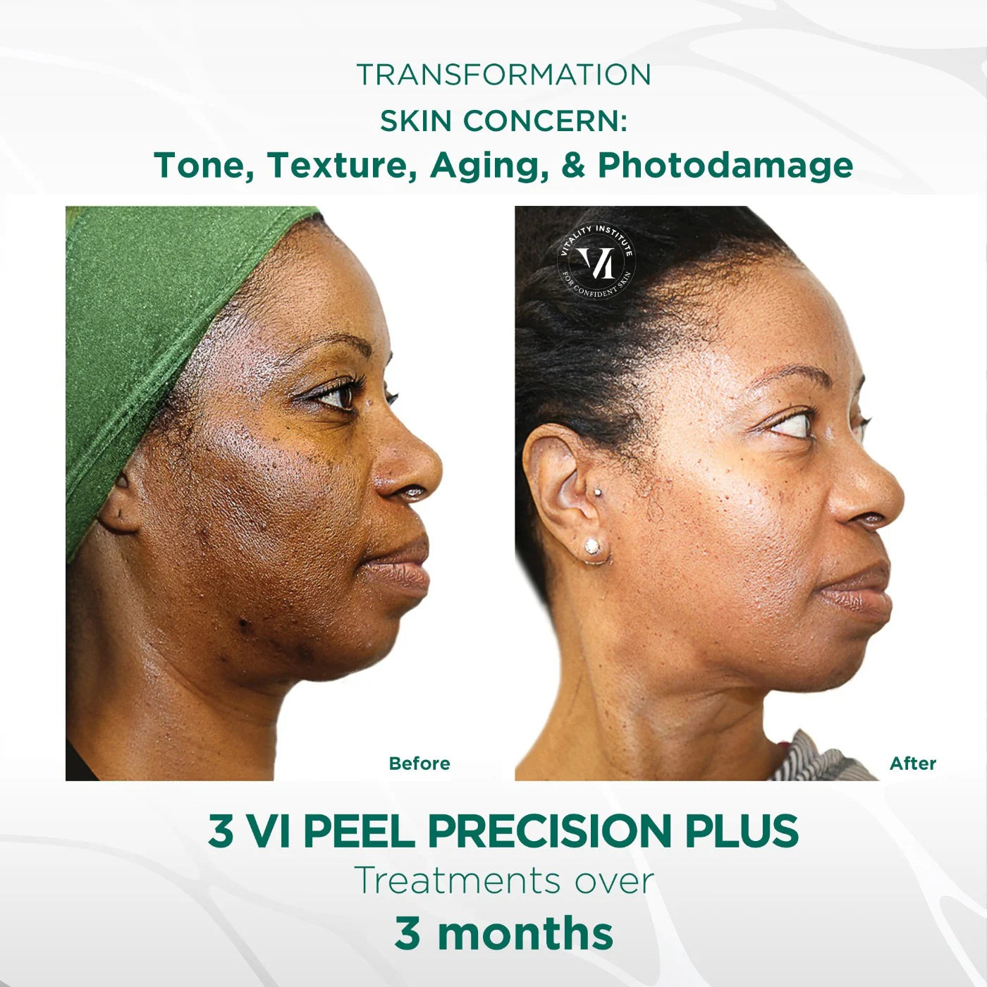 VI Peel-Precision Plus